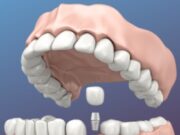 Зубы за 1 день: особенности одноэтапной имплантации с немедленной нагрузкой