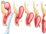 Симптомы опущения матки