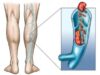Тромбоз нижних конечностей: причины и лечение