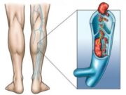 Тромбоз нижних конечностей: причины и лечение