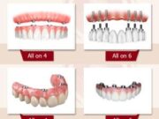 Чем отличается имплантация зубов All-on-4 от All-on-6?