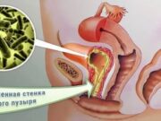 Как возникает цистит?