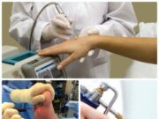 Методы удаления бородавок