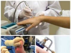 Методы удаления бородавок