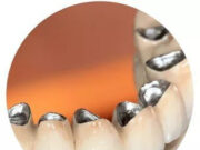 Особенности протезирования зубов металлокерамикой