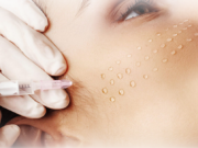 Когда нужна биоревитализация лица?