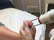 Удаление бородавок