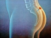 Причины появления кисты копчика