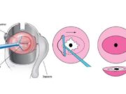 Методы лечения эрозии шейки матки