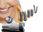 Преимущество имплантов OSSTEM