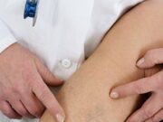 Причины возникновения сосудистых звездочек на ногах