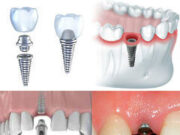 Имплантация зубов: преимущества, особенности, этапы проведения процедуры