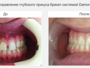 Что делать, если неправильный прикус?