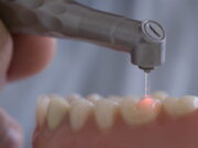 Современные методы лечения кариеса