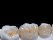 Керамическая вкладка на зуб: промежуточное звено между пломбой и коронкой