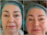 Плазмолифтинг лица: что за процедура и в каких случаях она проводится?