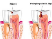 Виды кариеса и методы его профилактики