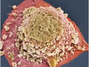 Разновидности карциномы и ее лечение?