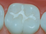 Серебрение зубов: консервативный метод лечения кариеса молочных зубов