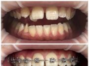 Какие брекеты лучше ставить взрослому человеку?