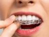 Особенности лечения на брекетах и элайнерах