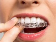 Особенности лечения на брекетах и элайнерах