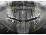 Для чего нужна ортопантомограмма ?