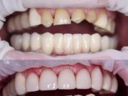 Как и где лучше восстановить зубной ряд и сэкономить на реставрации единицы?