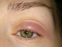 Отечность век: причины появления