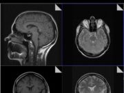 МРТ гипофиза: когда требуется исследование и как оно проходит
