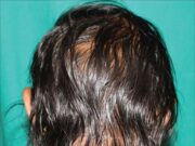 Алопеция, ее разновидности и симптоматика