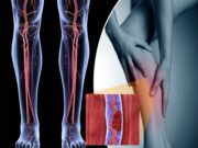 Причины тромбозов глубоких вен