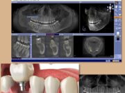 Имплантация зубов : советы по подготовке перед операцией