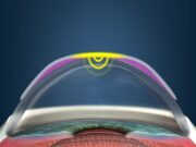 Ортолинзы — что это такое, можно ли восстановить зрение без операции?