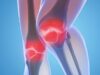 Лечение артроза коленного сустава: лучшие методы
