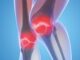 Лечение артроза коленного сустава: лучшие методы