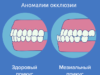Виды неправильного прикуса