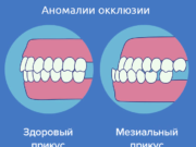 Виды неправильного прикуса