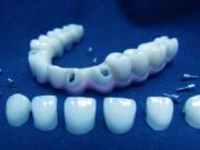 Этапы установки циркониевых коронок