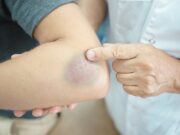 Ушиб мягких тканей : одна из самых распространенных травм