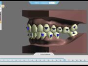 Современные технологии моделирования прикуса