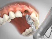 Когда пора ставить имплантат?