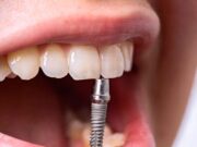 Что представляет собой дентальная имплантация?