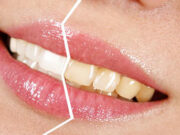 Потемнение зубов: заболевания и привычки