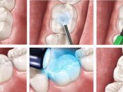 Этапы лечения кариеса