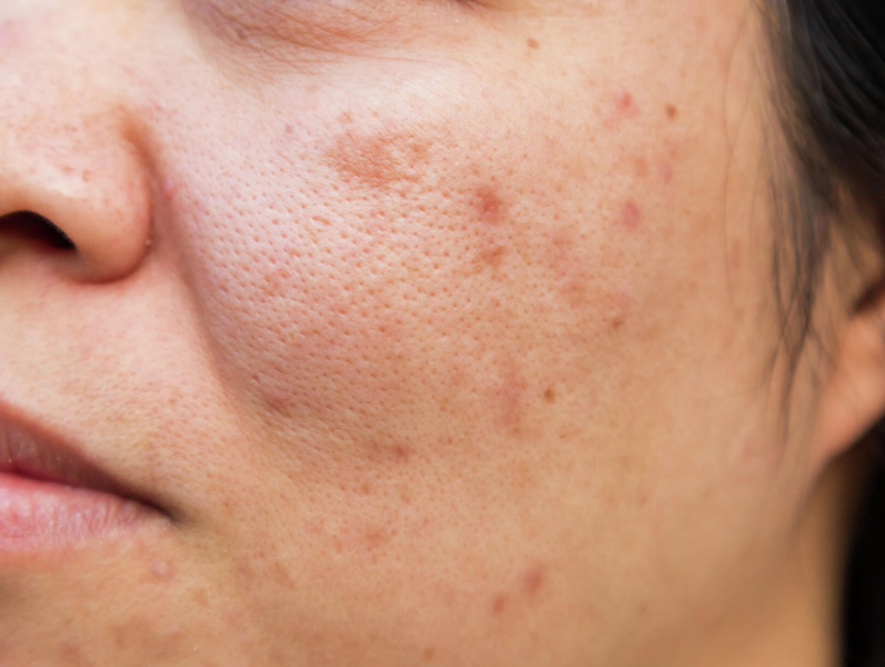Аллергия: почему возникает, в чем проявляется, как ее лечить