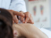 Иглоукалывание при лечении от алкоголизма