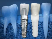 Установка имплантов Dentis