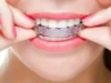 Какие нарушения прикуса можно исправить элайнерами?