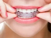 Какие нарушения прикуса можно исправить элайнерами?